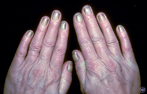 سندرم ناخن زرد Yellow nail syndrome
