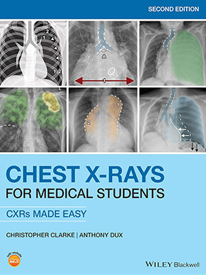 دانلود کتاب تفسیر رادیوگرافی ریه و قفسه سینه Chest X-Rays for Medical Students: CXRs Made Easy