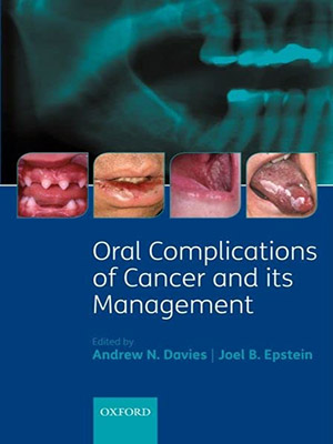 دانلود کتاب عوارض دهانی سرطان و مدیریت آن Oral Complications of Cancer and its Management